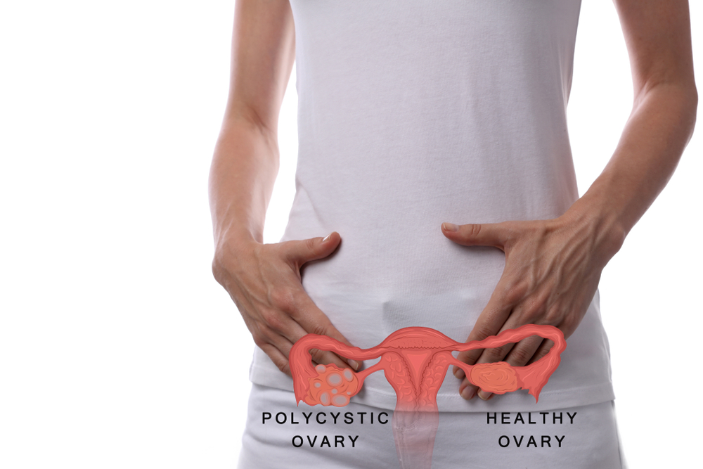 How Does PCOS Affect Fertility?