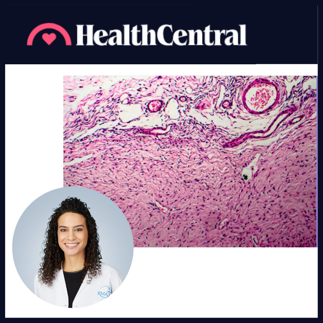 Ovarian Cysts and Bloating: What You Need to Know